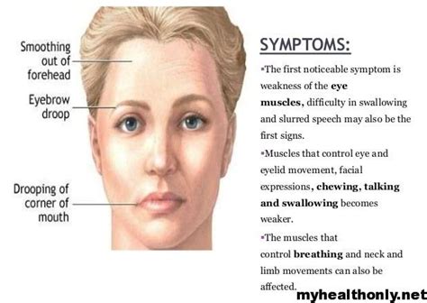 Myasthenia Gravis: 5 Symptoms You Can't Ignore!
